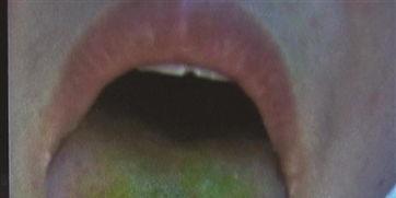 吃瓜后舌头难受,揭秘夏日消暑美食的副作用 第1张 吃瓜后舌头难受,揭秘夏日消暑美食的副作用 第1张